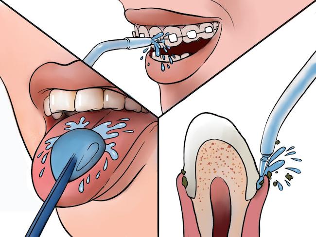Как пользоваться ирригатором для полости рта