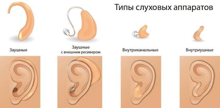 Какой слуховой аппарат выбрать - Рейтинг лучших